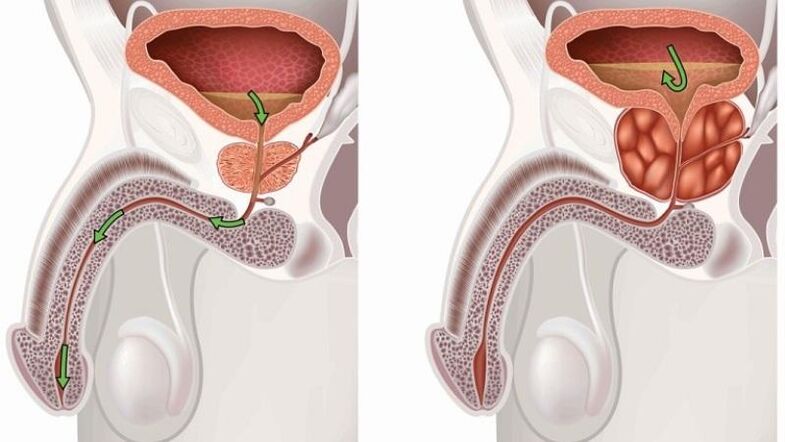 stagnation de l'urine à propos de la prostatite